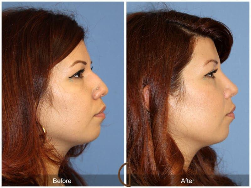 Ethnic Rhinoplasty Before & After Photo