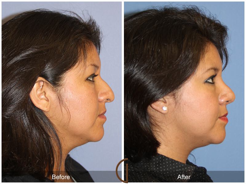 Ethnic Rhinoplasty Before & After Photo