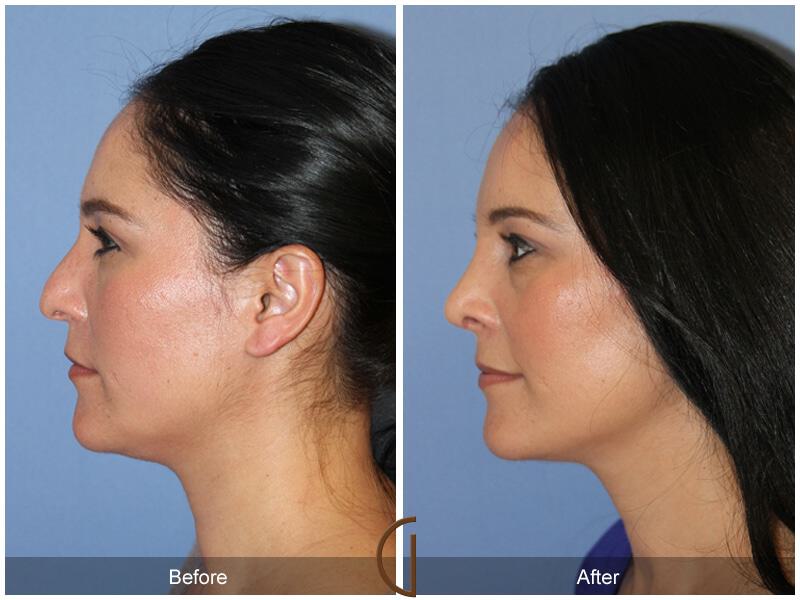 Female Rhinoplasty Before & After Photo