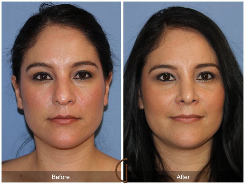 Female Rhinoplasty Before & After Photo