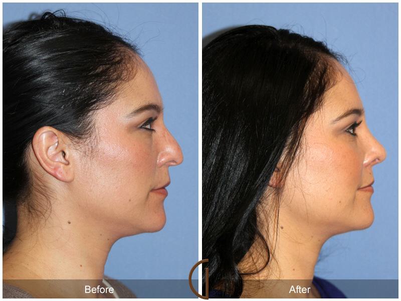 Female Rhinoplasty Before & After Photo