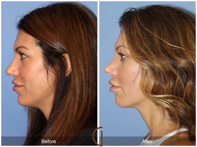 Female Rhinoplasty Before & After Photo