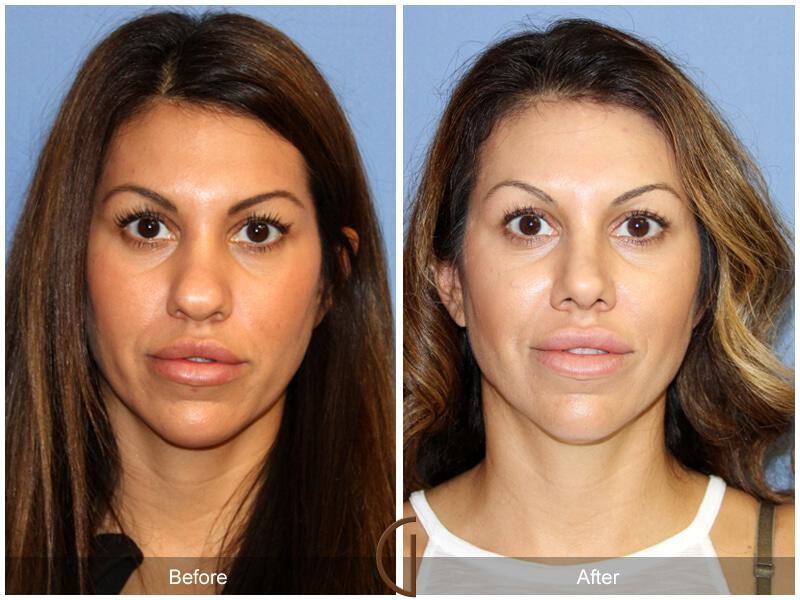 Female Rhinoplasty Before & After Photo