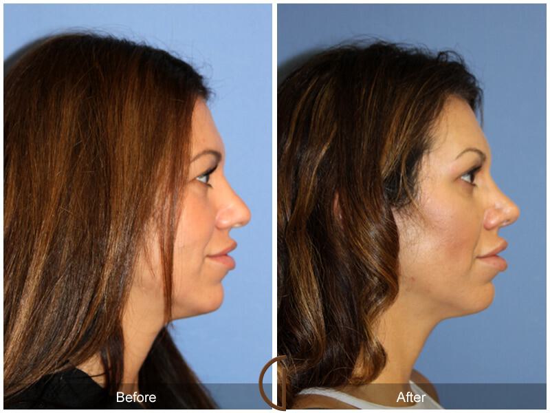 Female Rhinoplasty Before & After Photo