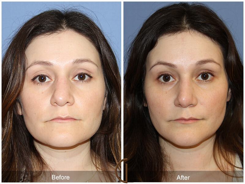 Female Rhinoplasty Before & After Photo