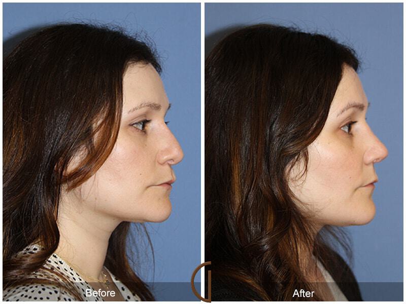 Female Rhinoplasty Before & After Photo