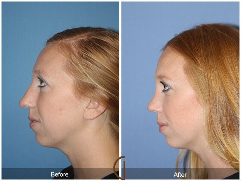 Female Rhinoplasty Before & After Photo