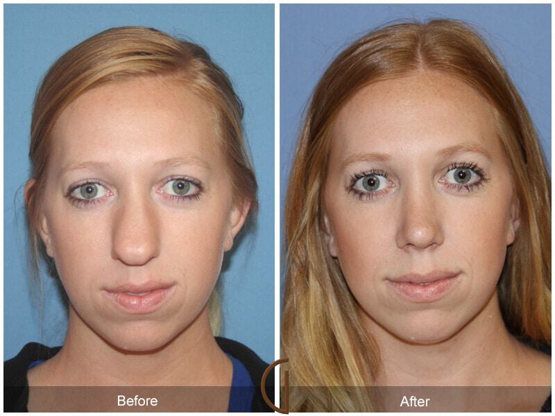 Female Rhinoplasty Before & After Photo