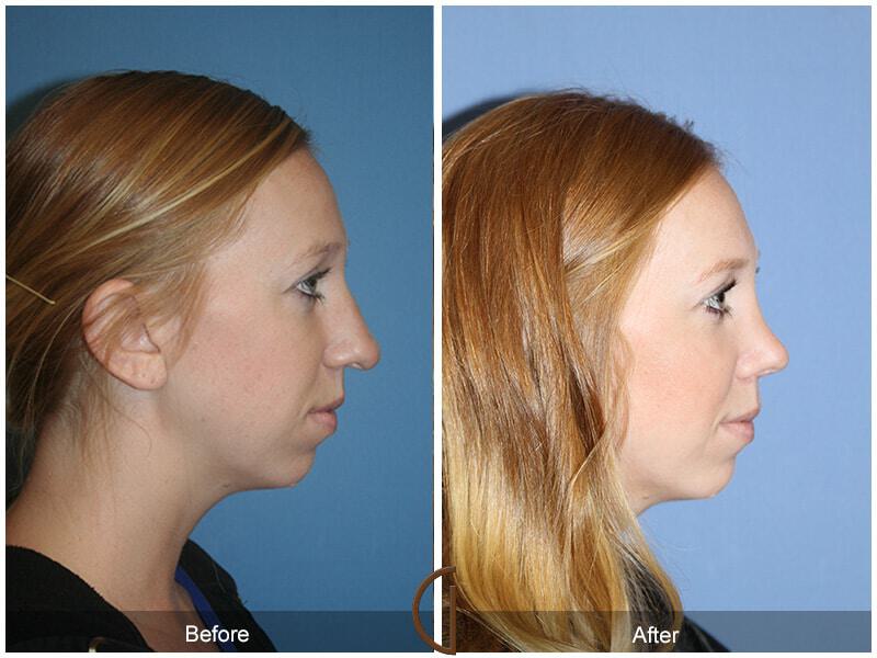 Female Rhinoplasty Before & After Photo