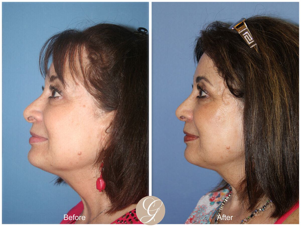 Female Rhinoplasty Before & After Photo