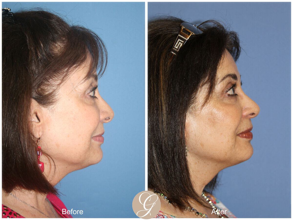 Female Rhinoplasty Before & After Photo