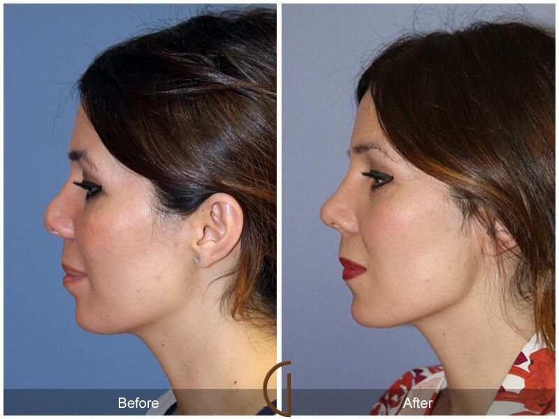 Female Rhinoplasty Before & After Photo