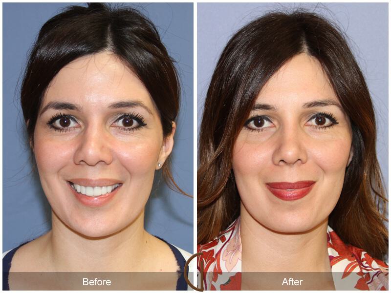 Female Rhinoplasty Before & After Photo