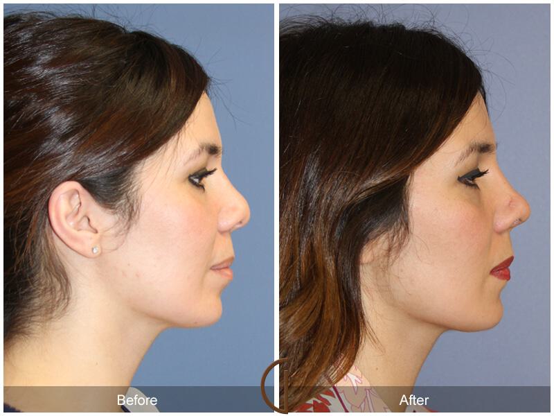 Female Rhinoplasty Before & After Photo