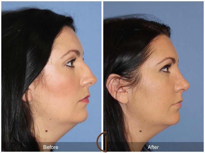 Female Rhinoplasty Before & After Photo