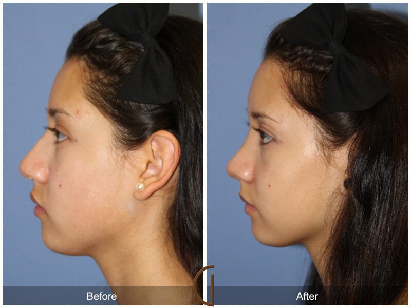 Female Rhinoplasty Before & After Photo