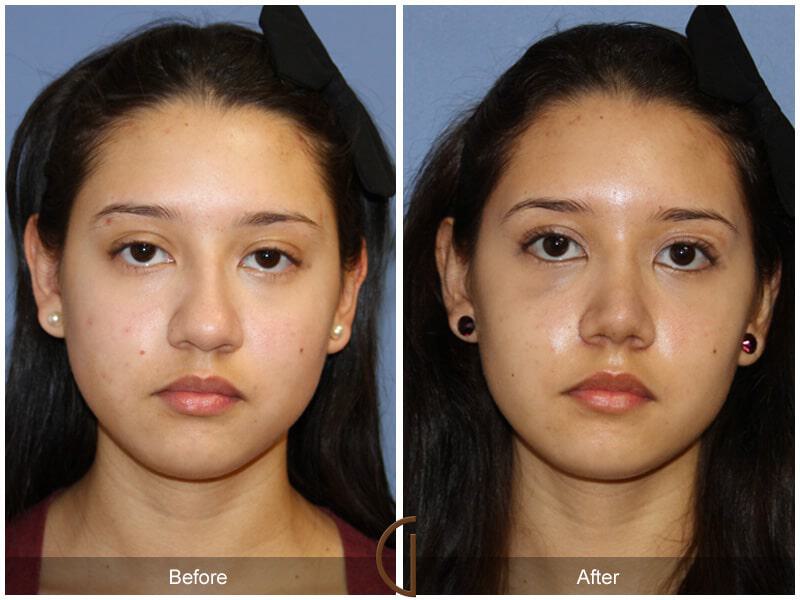 Female Rhinoplasty Before & After Photo