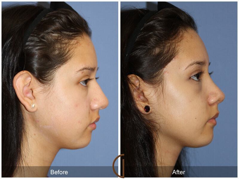 Female Rhinoplasty Before & After Photo