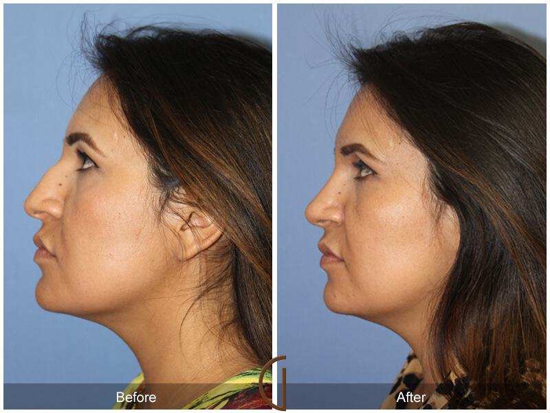 Female Rhinoplasty Before & After Photo