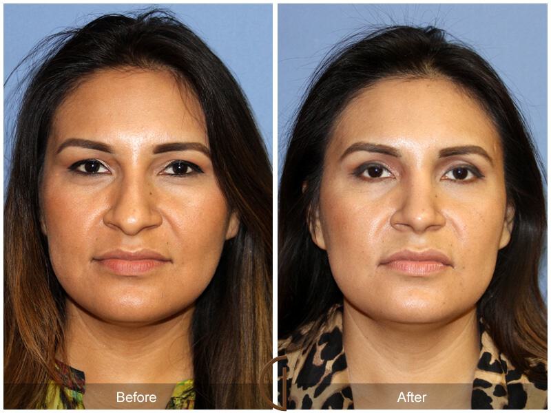 Female Rhinoplasty Before & After Photo