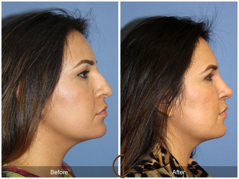 Female Rhinoplasty Before & After Photo