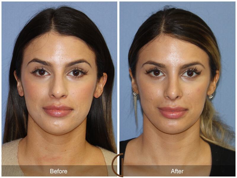 Female Rhinoplasty Before & After Photo