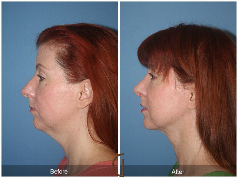 Female Rhinoplasty Before & After Photo