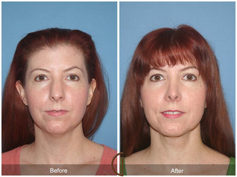 Female Rhinoplasty Before & After Photo