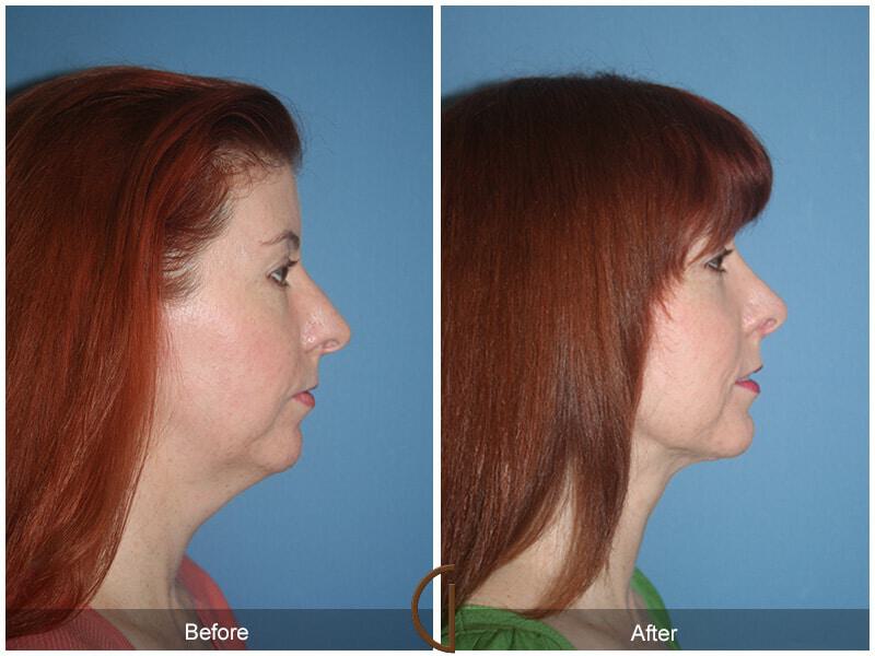 Female Rhinoplasty Before & After Photo