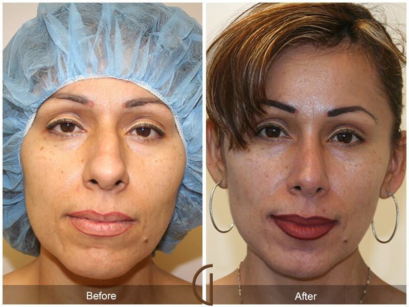 Female Rhinoplasty Before & After Photo