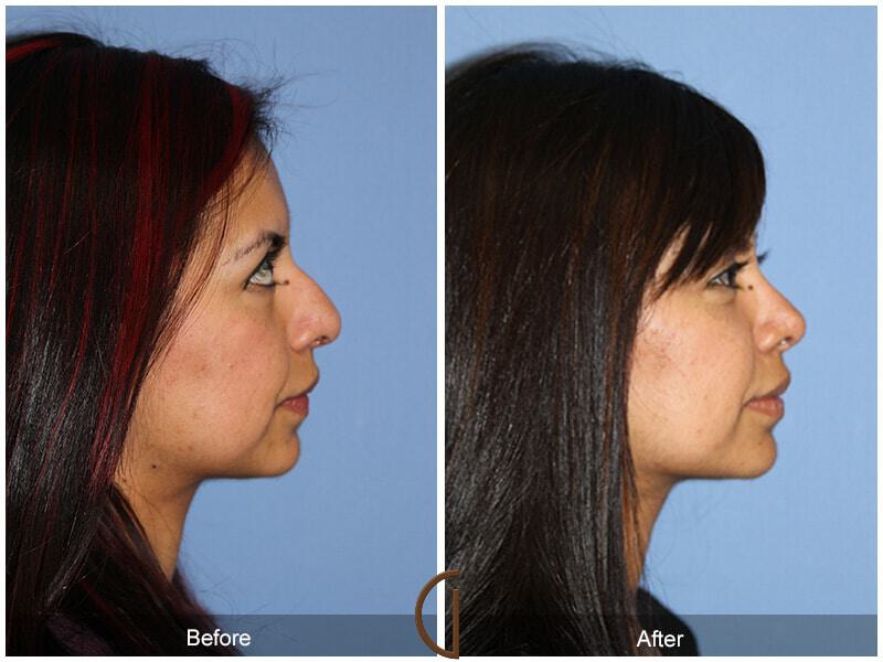 Female Rhinoplasty Before & After Photo