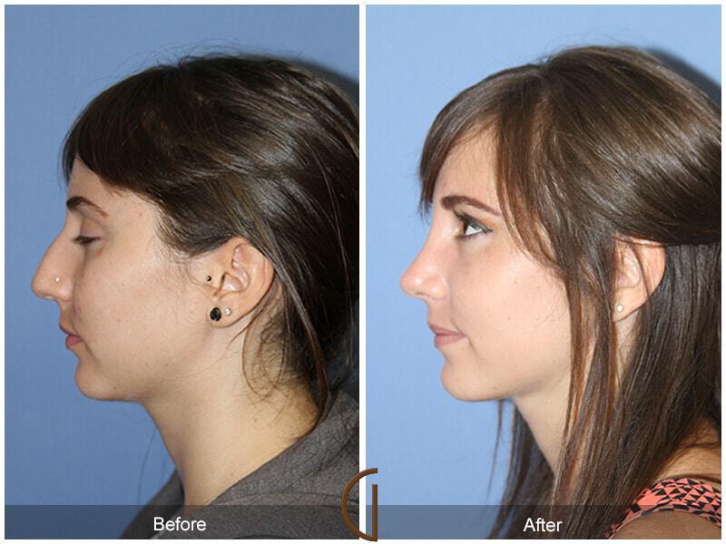 Female Rhinoplasty Before & After Photo