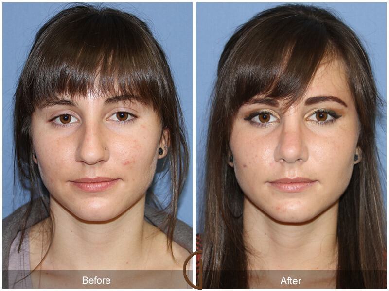 Female Rhinoplasty Before & After Photo