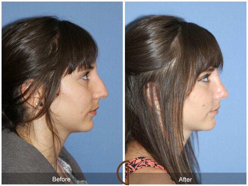 Female Rhinoplasty Before & After Photo