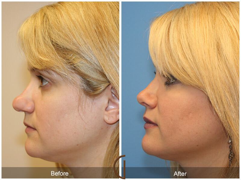 Female Rhinoplasty Before & After Photo