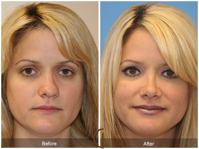 Female Rhinoplasty Before & After Photo