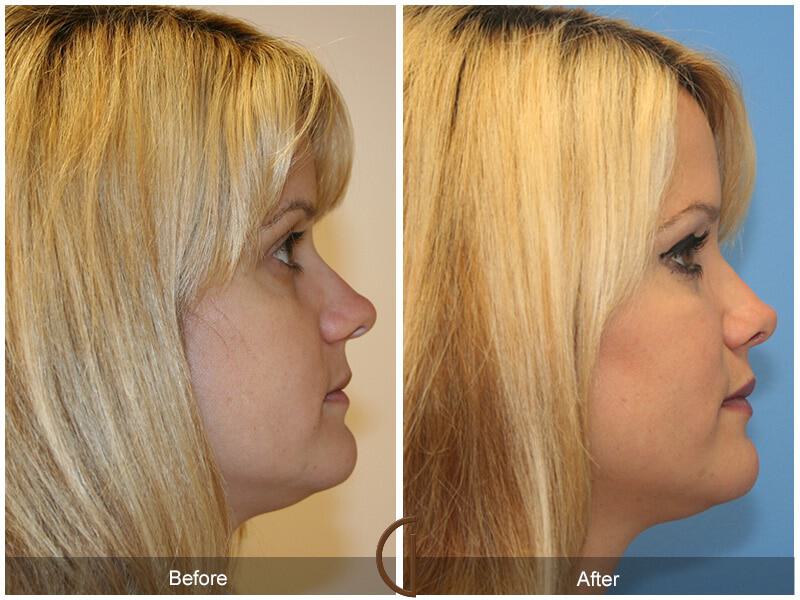 Female Rhinoplasty Before & After Photo