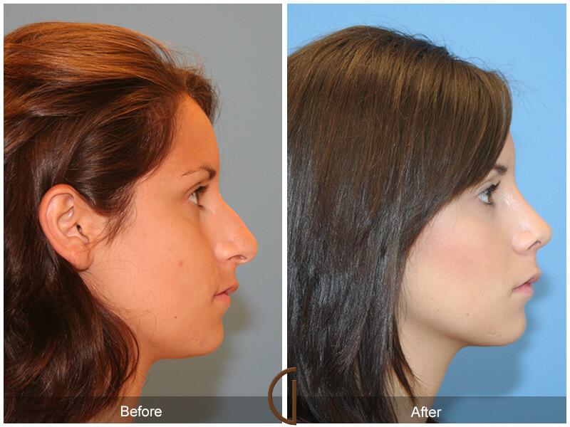 Female Rhinoplasty Before & After Photo