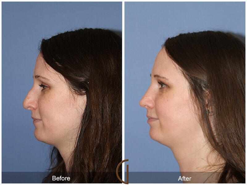 Female Rhinoplasty Before & After Photo