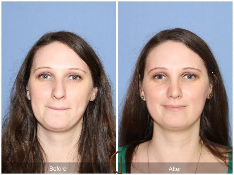 Female Rhinoplasty Before & After Photo