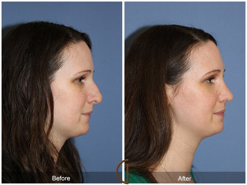 Female Rhinoplasty Before & After Photo