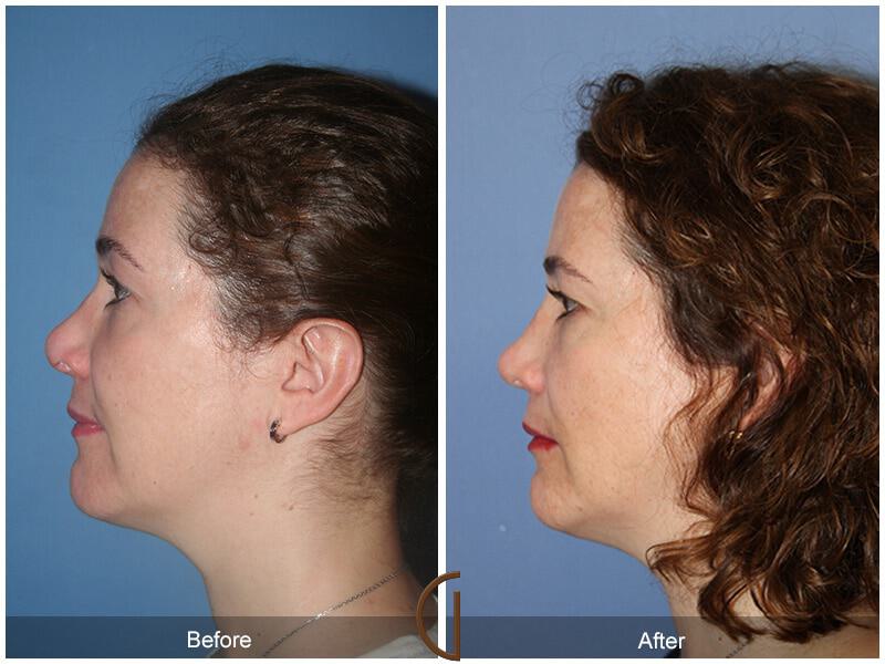 Female Rhinoplasty Before & After Photo