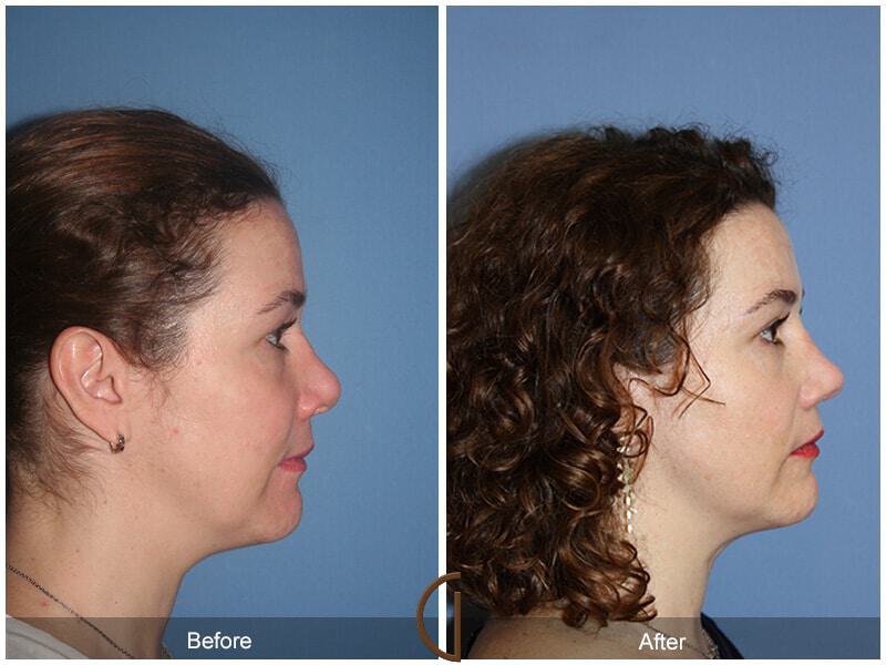 Female Rhinoplasty Before & After Photo