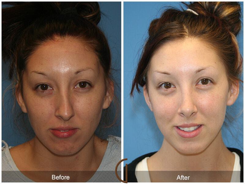 Female Rhinoplasty Before & After Photo