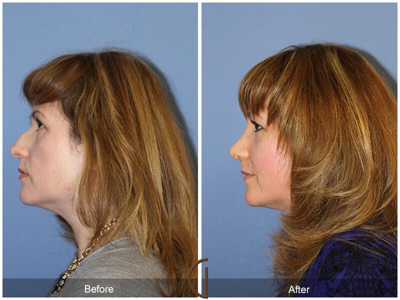 Female Rhinoplasty Before & After Photo