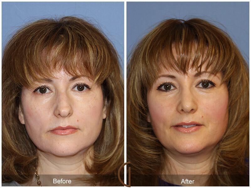 Female Rhinoplasty Before & After Photo