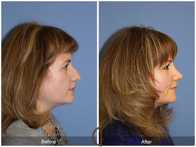 Female Rhinoplasty Before & After Photo