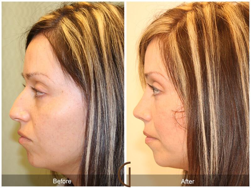 Female Rhinoplasty Before & After Photo