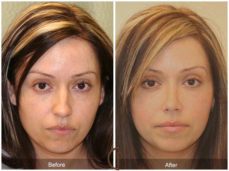 Female Rhinoplasty Before & After Photo