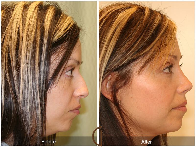 Female Rhinoplasty Before & After Photo